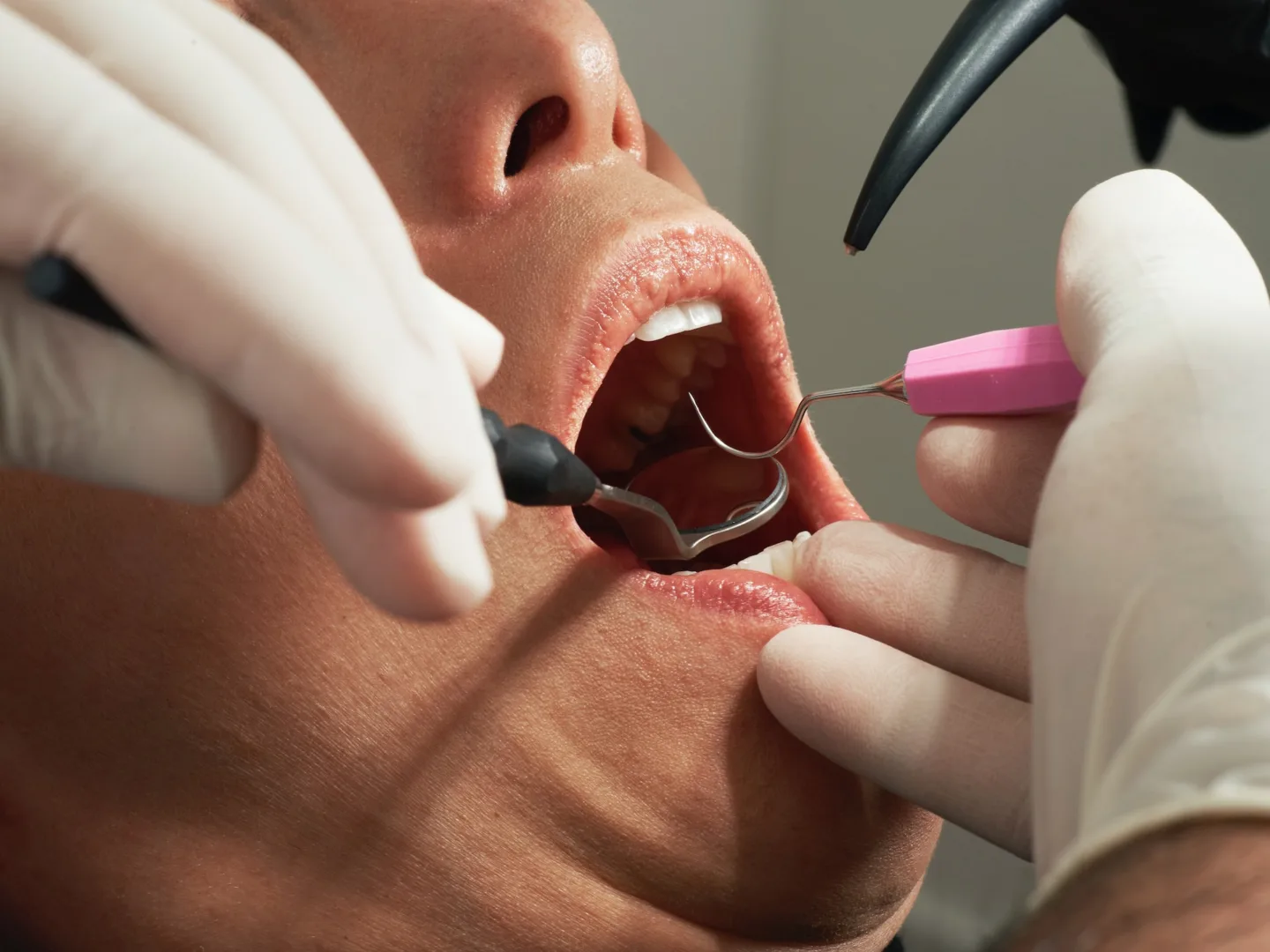 Jeśli na Twoich ustach pojawiła się opryszczka, lepiej odwołaj wizytę u dentysty.