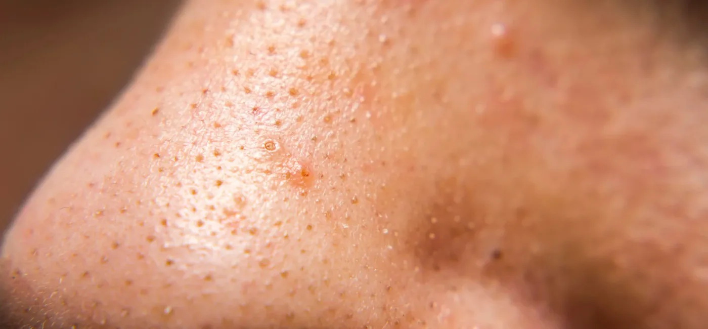 Jak walczyć z zaskórnikami? Praktyczne porady.