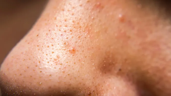 Jak walczyć z zaskórnikami? Praktyczne porady.