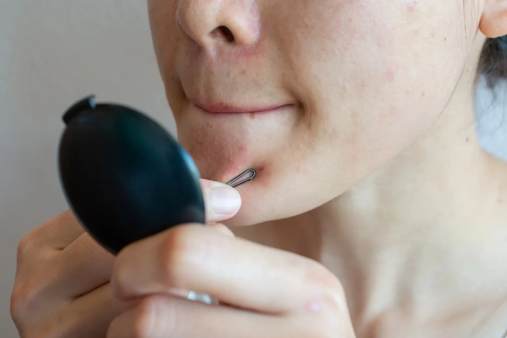 Jak walczyć z zaskórnikami? Praktyczne porady.